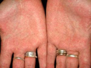 1Scarlatina