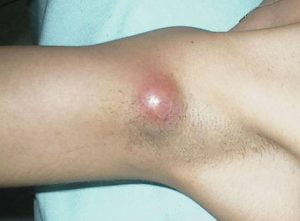 1fir de par sub piele