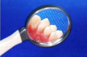 1inflamatia gingiilor