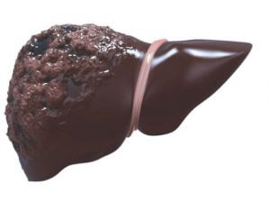 1ciroza hepatica