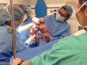 DIVINITATEA a vrut ca aceste GEMENE sa se nasca tinandu-se de mana! Sunt PERFECT SANATOASE desi au fost diagnosticate inainte de NASTERE cu o afectiune foarte rara! VIDEO