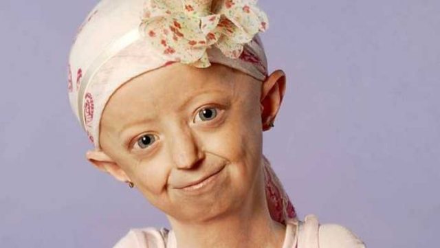 progeria