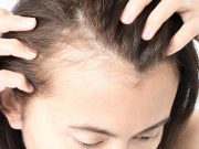 Remediul care previne aparitia calvitiei