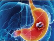 O noua teorie a oamenilor de stiinta ar putea duce la vindecarea cancerului!
