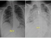 Cum se distrug in trei zile plămânii unui tânăr de 28 de ani infectat cu coronavirus?