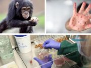 Reteaua Mondiala de Sanatate (WHN) a declarat pandemie de variola maimutei